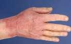 Dermatite allergica sulle mani