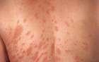 Dermatite allergica